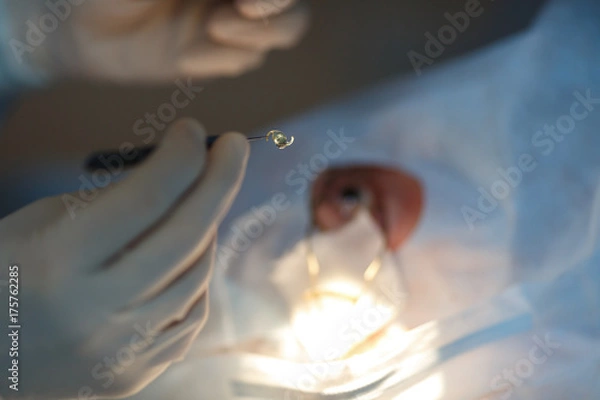 Fototapeta Операция по далению катаракты глаза