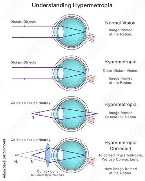 Fototapeta Labeled Diagram Explaining Eye Defect Hypermetropia and Its Image Formation