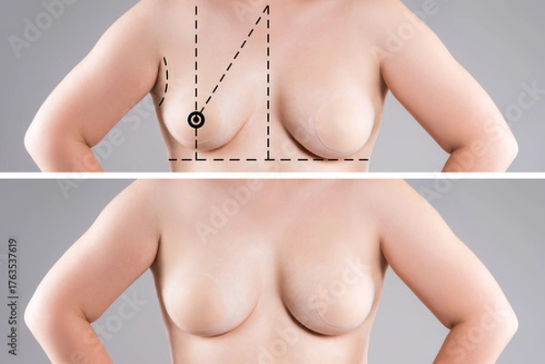Obraz Before and after breast augmentation, woman with asymmetric saggy breasts, reduction mammoplasty, aesthetic plastic surgery, healthcare and medicine concept