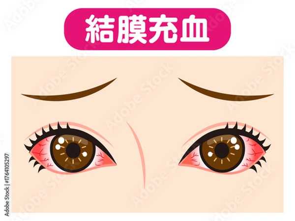 Obraz 	結膜充血で充血した両目のイラスト素材