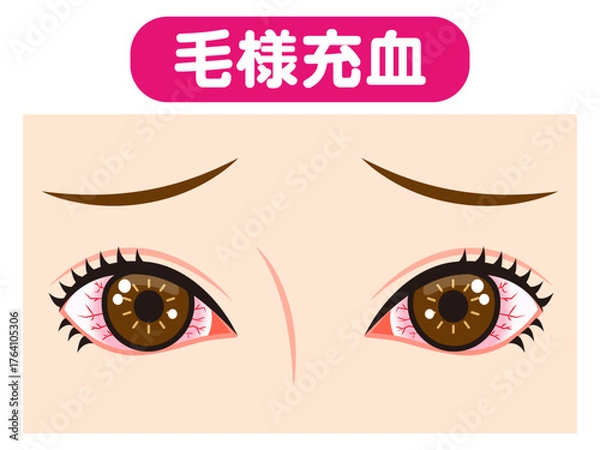 Obraz 	毛様充血で充血した両目のイラスト素材