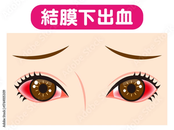 Obraz 	結膜下出血で充血した両目のイラスト素材