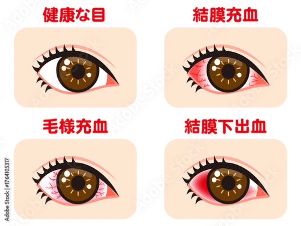 Obraz 充血する片目の図解イラスト素材セット