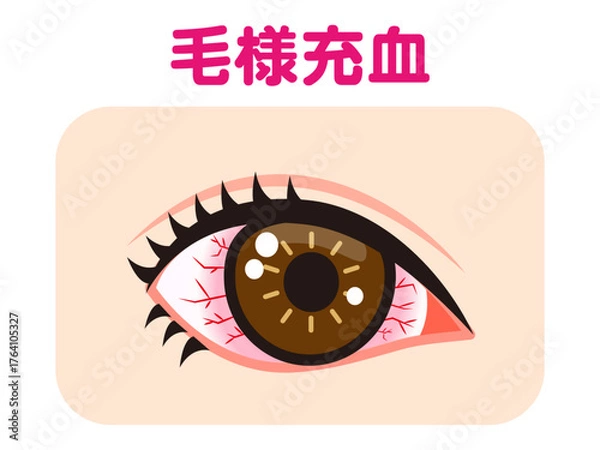 Obraz 	毛様充血で充血した片目のイラスト素材