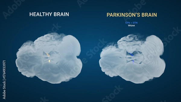 Obraz Parkinsons GPe STN Weak Indirect Pathway Comparison