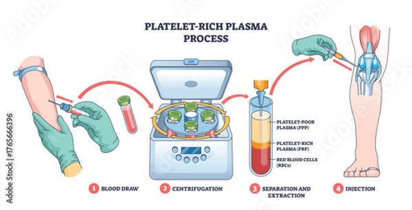 Fototapeta Platelet-rich plasma process shows blood draw, centrifuge separation, and PRP injection into the knee for healing, key objects, syringe, centrifuge, knee joint. Outline diagram