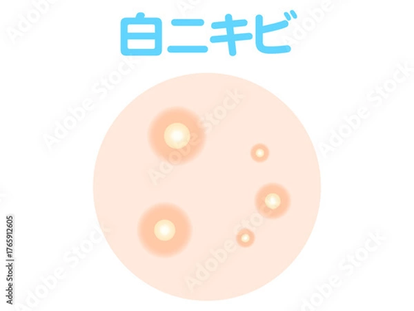 Obraz 	白ニキビのイラスト素材