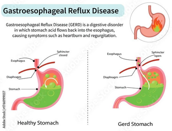 Fototapeta Gastroesophageal Reflux Disease (GERD) or Heartburn and Acid Reflux Illustration on White Background. Medical Diagram
