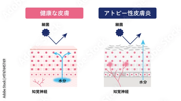 Obraz アトピー性皮膚炎