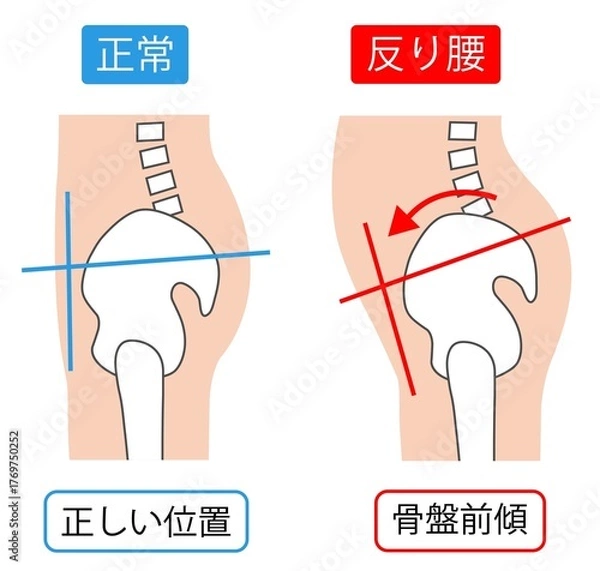Obraz 反り腰の骨盤前傾と正常な骨盤の位置