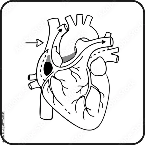 Fototapeta Coronary artery bypass graft