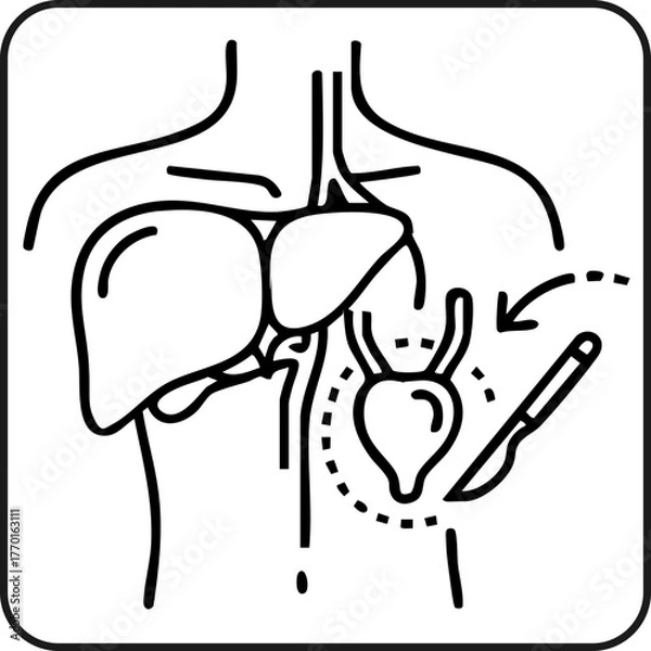 Fototapeta Cholecystectomy