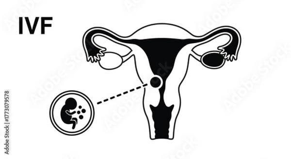 Fototapeta Diagram illustrates the process of In Vitro Fertilization (IVF) to achieve pregnancy, depicting a fetus and embryos.