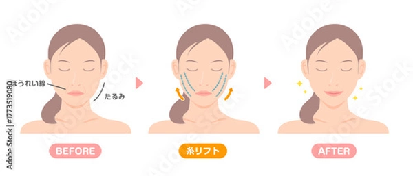 Obraz 糸リフトの施術内容と効果 ベクターイラスト