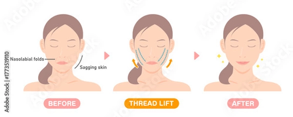 Obraz Vector illustration of how a thread lift works