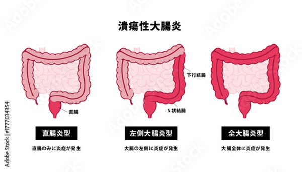 Obraz 潰瘍性大腸炎の種類　ベクターイラストセット