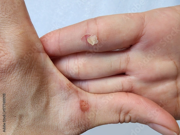Fototapeta Hands with blisters, abrasions and scars on a white background