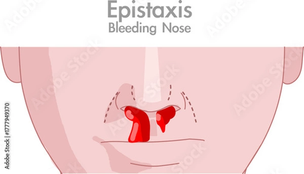 Fototapeta Epistaxis, bleeding from nose nosebleed drops blood flow. Human intelligence, medical draw. Vector illustration