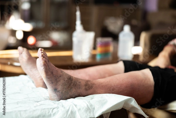 Fototapeta An intimate close-up view of a person's feet and legs, showcasing the texture of the skin and details of discoloration, inviting contemplation on age and health conditions.