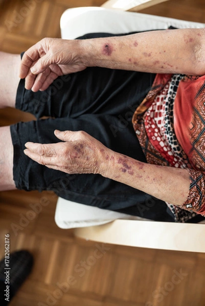 Fototapeta The image captures the hands of an elderly woman, showcasing distinctive marks and textures that tell a story of life and experience, symbolizing wisdom and the passage of time.