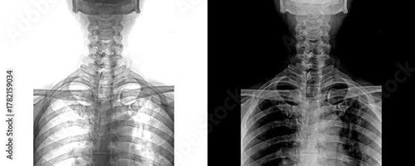 Obraz Neck Anterior View X-Ray Showing Vertebral Column for Identification and Structural Issues Isolated on Transparent Background