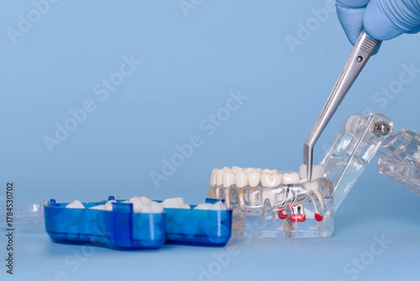 Fototapeta Dental prosthetic tooth placement on jaw model