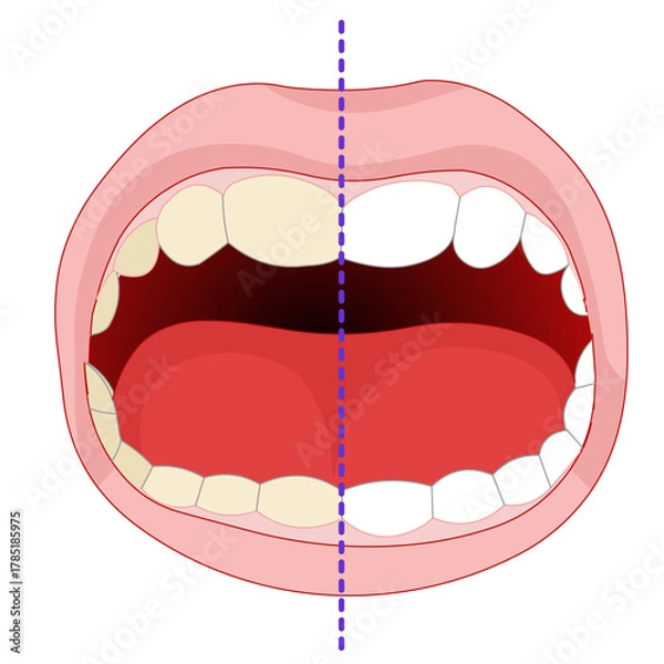 Fototapeta Teeth whitening  before after.  Home and office type tooth bleaching. Vector illustration