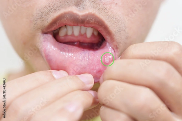 Obraz Mouth Ulcer Sore or Aphthous Stomatitis. Oral Health and Medical concepts