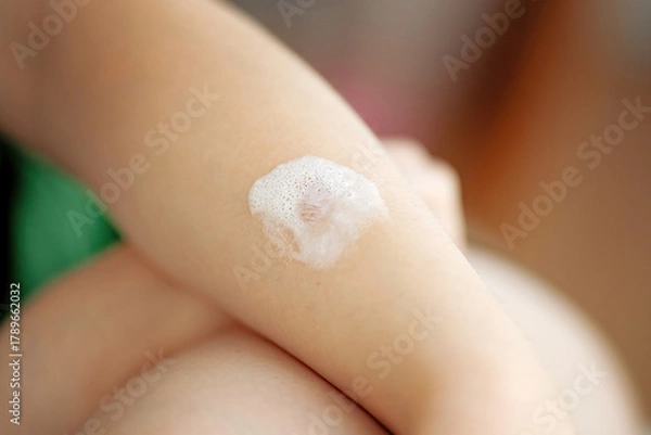 Fototapeta Teen's hand with minor thermal burn treated with medicinal pain-relief foam