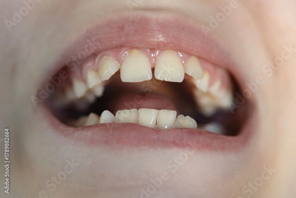 Fototapeta Close-up view of a child's mouth showing baby teeth and gaps, highlighting dental development and growth stages