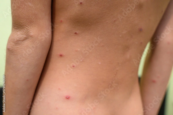 Obraz Boy with chickenpox. Rash on child body 