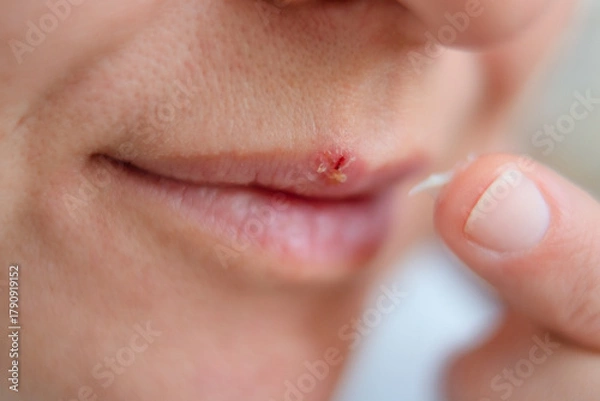 Obraz Female lips close up with cold sore. Girl uses finger to apply cream for herpes treatment. Concept of illness, care, and health protection.