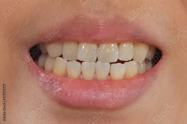 Obraz Yellow Teeth Problem