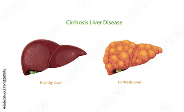 Fototapeta Cirrhosis Liver Disease