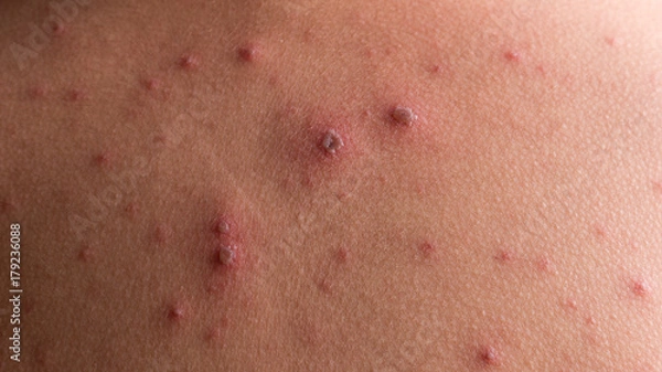 Obraz Chicken pox rash
