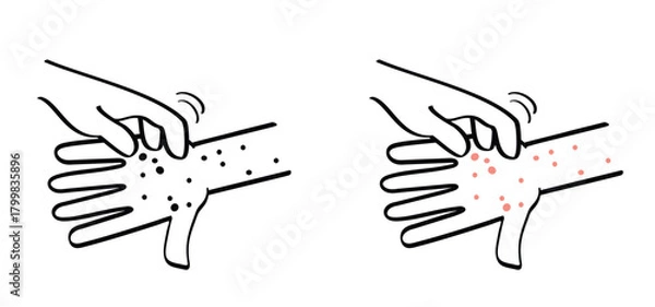 Fototapeta Skin rash, measles on hand. allergy causing itching, skin irritation. Red rash on the body. food allergy orother autoimmune diseases. Rubeola or morbilli symptom. food allergy. Eczema, smallpox.