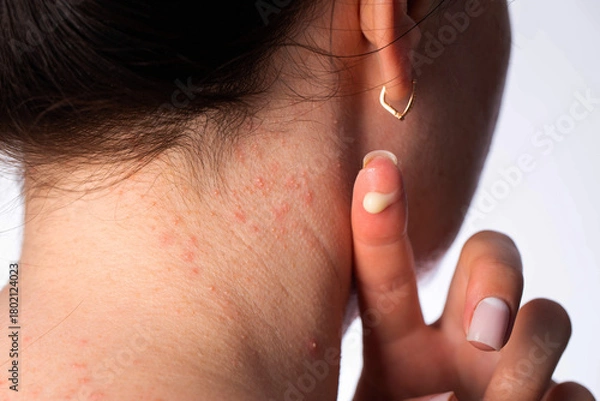 Fototapeta Medicinal cream on a girl's finger against the background of an ear and neck with red pimples and rashes, close-up