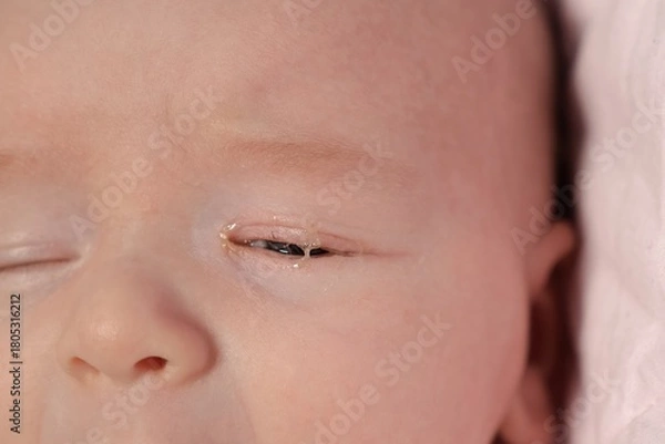 Fototapeta Baby eyes with eye mucus in selective focus. Disease tear ducts tons of newborns close up. Nasolacrimal duct obstruction in baby it is a blockage of the lacrimal drainage system. 