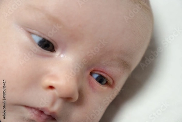 Fototapeta Baby eyes with eye mucus in selective focus. Disease tear ducts tons of newborns close up. Nasolacrimal duct obstruction in baby it is a blockage of the lacrimal drainage system. 