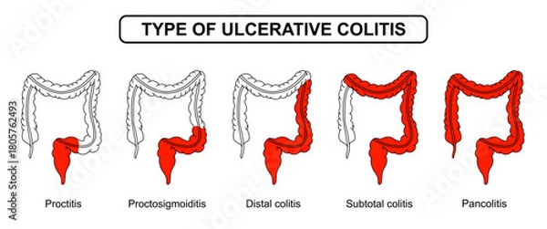 Fototapeta Illustration types of ulcerative colitis. Inflammation of the human digestive system. Inflammatory bowel disease, Inflammation of the human digestive system. Vector drawing illustration for medical