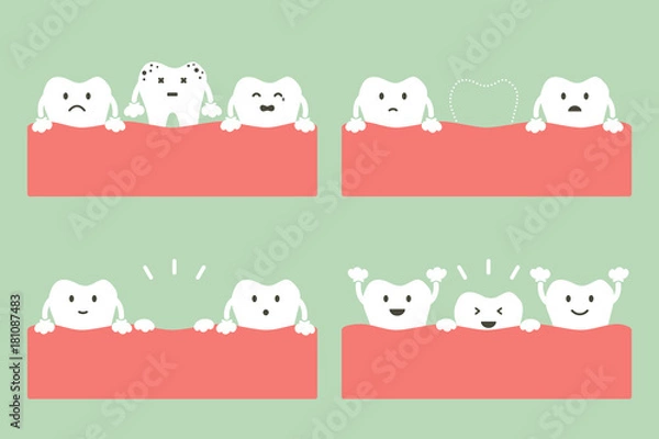 Fototapeta step of caries to first teeth