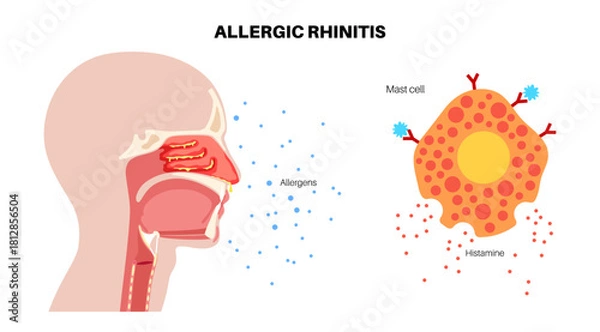 Obraz Allergic rhinitis poster