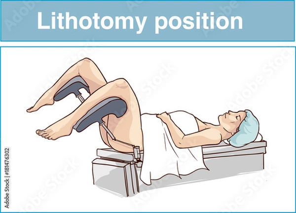 Obraz Lithotomy position