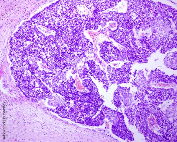 Obraz Urinary bladder. Transitional cell carcinoma