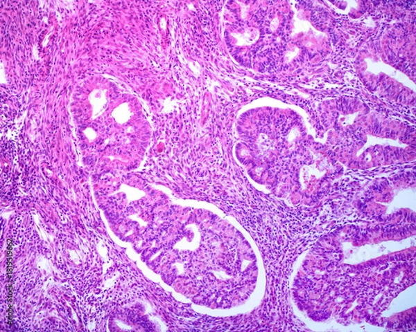 Obraz Endometrium. Carcinoma
