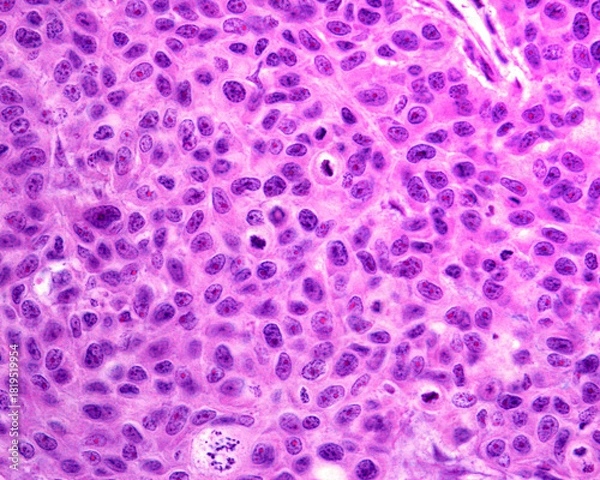 Obraz Cancerous epithelial cells