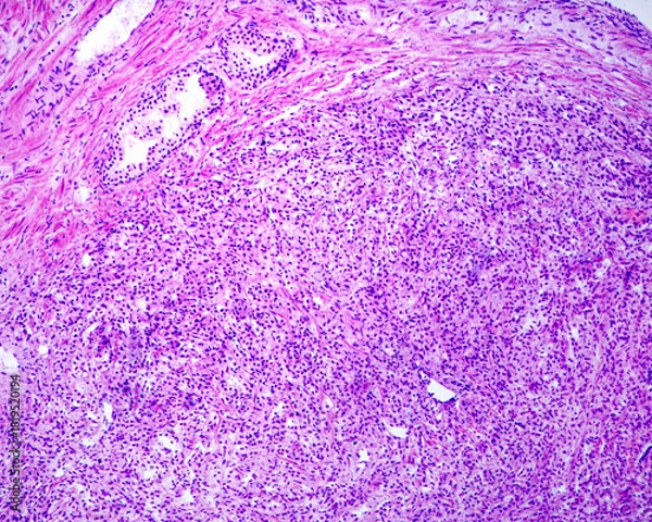 Obraz Prostate adenocarcinoma