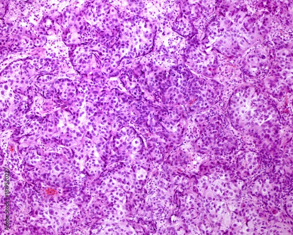 Obraz Urinary bladder. Transitional cell carcinoma