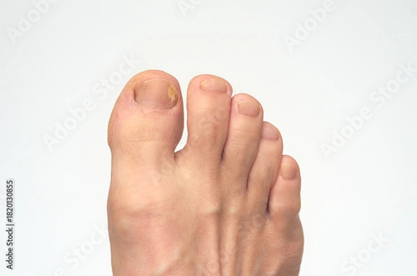 Obraz 남성의 발톱 무좀 클로즈업 흰색배경