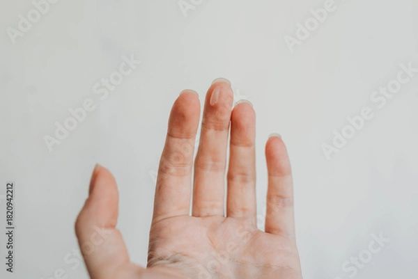 Fototapeta Close-up of a woman’s hand with skin irritation on the finger — real skin texture, dermatology concept